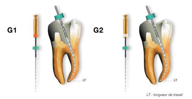 Le protocole de départ est identique à celui réalisé lors d un traitement endodontique utilisant un autre système de préparation canalaire.