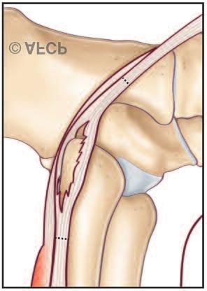 L ANATOMIE Les tendons fibulaires occupent la loge latérale (externe) de la jambe et passent en arrière de la malléole latérale dans un tunnel formé par l os en avant et le rétinaculum des fibulaires