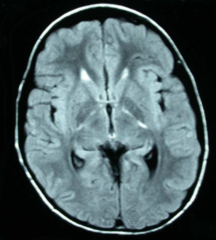 OBSERVATION Imagerie Angio-IRM cérébrale: persistance de l hypersignal du