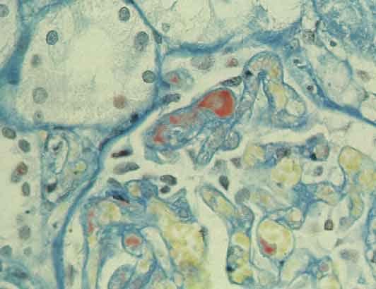 Au niveau macroscopique : la macroscopie est peu parlante. Dans la période précoce de la maladie, le rein apparaît de taille normale ou augmentée, souvent parsemé de pétéchies sous-capsulaires.