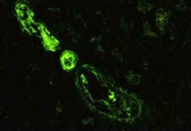 Immunofluorescence : L étude de Segonds et al [58] montre la présence constante de fibrine et de fibrinogène dans le mésangium, les parois des capillaires glomérulaires et artériolaires.