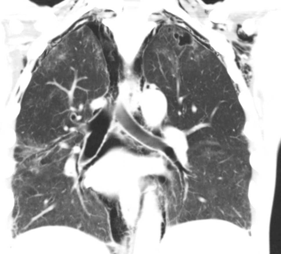 La pneumopathie à CMV, observée dans des circonstances analogues (phase précoce, après la
