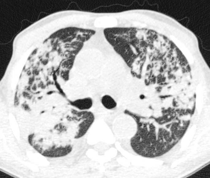 pneumonie lobaire (segmentaire).