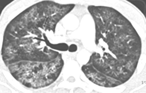 respect des zones corticales, sous pleurales Pneumocystose pulmonaire inaugurale chez