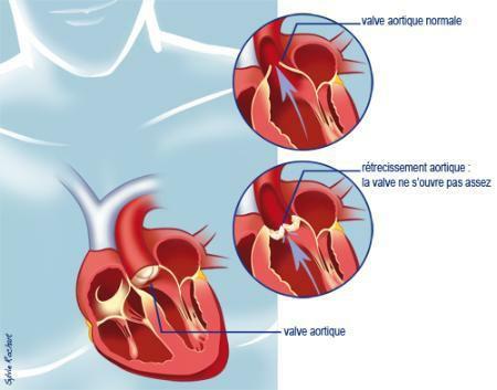une insuffisance cardiaque. Quelles peuvent être les causes de mon rétrécissement aortique?