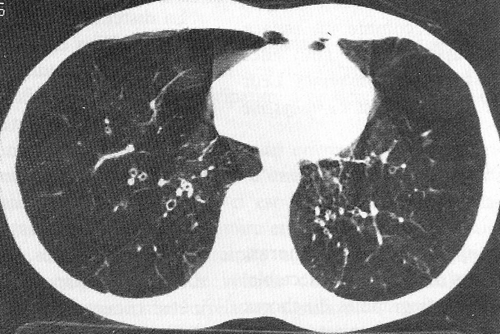 e Lésions du parenchyme pulmonaire : Lésions d emphysème
