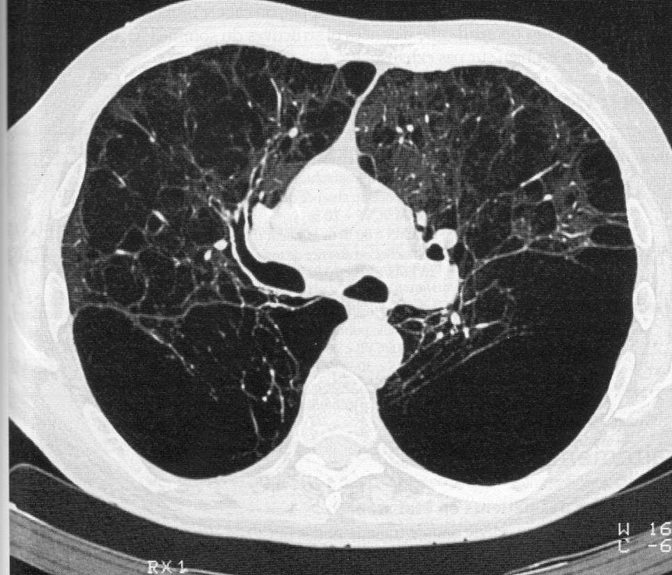 Anatomopathologie Lésions du parenchyme pulmonaire : Lésions
