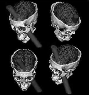 Le lobe frontal est composé du cortex moteur primaire (aire IV de Brodman).