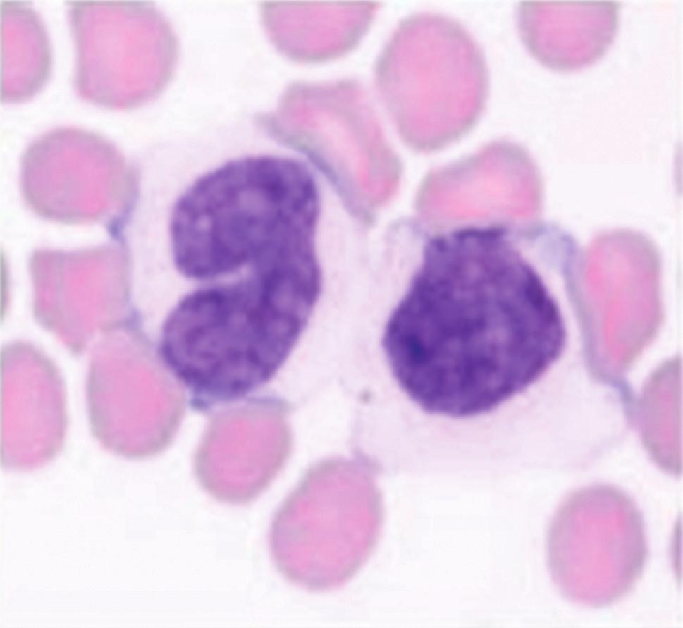 Une étérogénéité cellulaire plus marquée (taille, surface) semble présente dans le groupe des LPLB sans iso q, mais ne permet cependant pas de les distinguer des patients avec isoq.