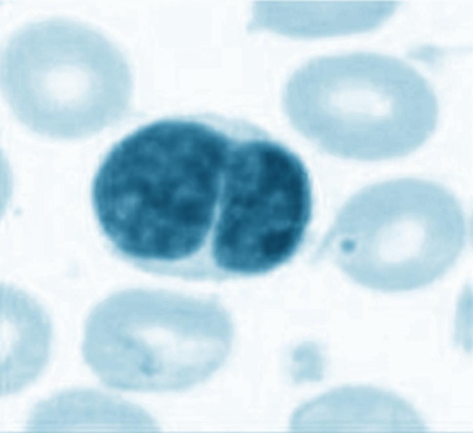 Étude morphologique des lymphocytes binucléés éventuels, en particulier concernant la forme du noyau, la présence de nucléole(s), la surface et la basophilie du cytoplasme.