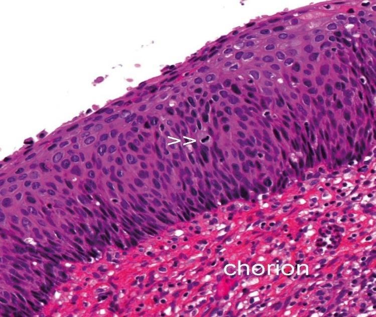 Le foyer infiltrant ne dépasse pas 5 mm en profondeur et 7 mm en largueur Carcinome invasif (au niveau du col) : dépassement de la membrane basale avec infiltration du chorion sous-jacent.