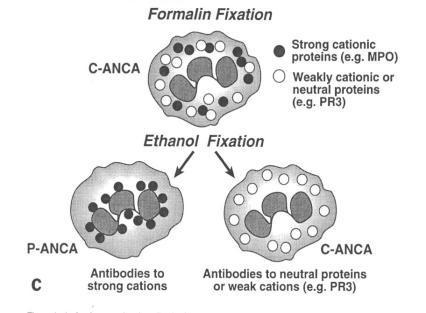 Aspect p-anca : artéfact de fixation à l éthanol éthanol permet migration vers le noyau chargé de protéines