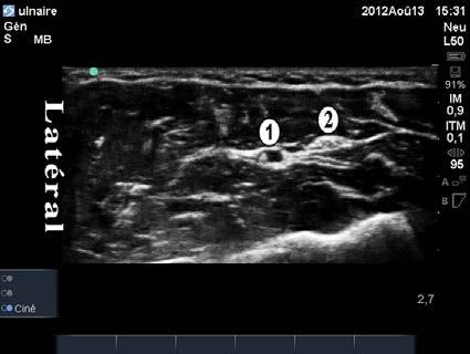 Entre ce dernier et le tendon du muscle fléchisseur superficiel destiné à l index, le nerf médian est repéré par sa structure alvéolée caractéristique.