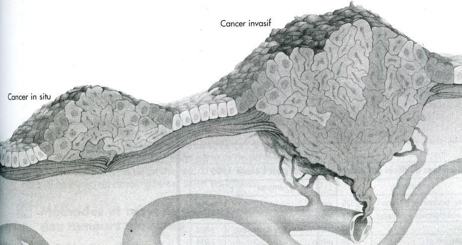 Processus tumoral 4 stades : hyperplasie, dysplasie, cancer in situ, cancer invasif Cancer in situ: tumeur maligne localisée (l amas de cellules tumorales