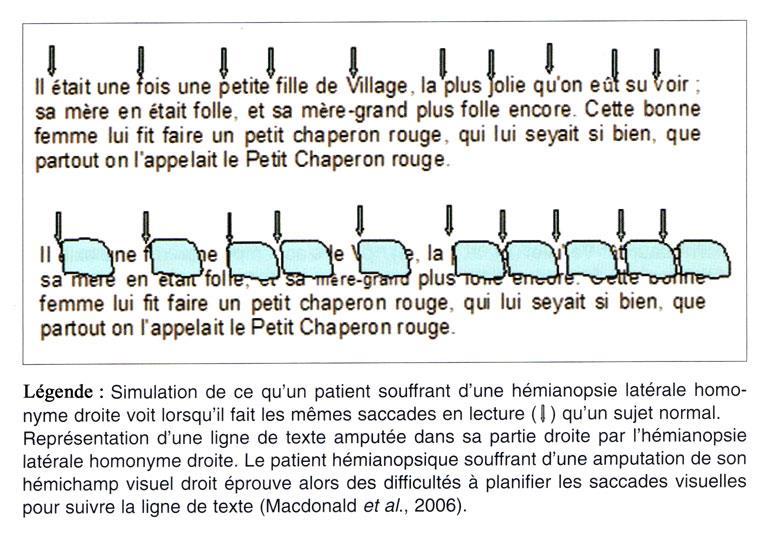 Figure 7 : Schématisation de la lecture chez un patient ayant une H.L.H droite (Chokron & Démonet, 2010)[28] p.