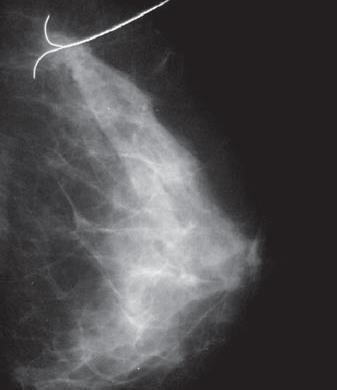 Technique référence: Harpon Avantages = Inconvénients = Précis Coût faible Vérification du positionnement en mammographie possible.