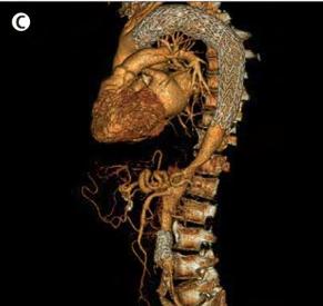 Haut risque de dissection aortique Traitement médical de l HTA +++ : - Béta-bloquants? - Inhibiteurs du récepteur AT II?
