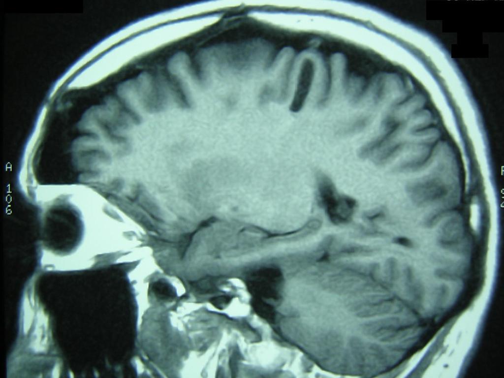 Malformations Artérioveineuses Cérébrales Un défi multidisciplinaire