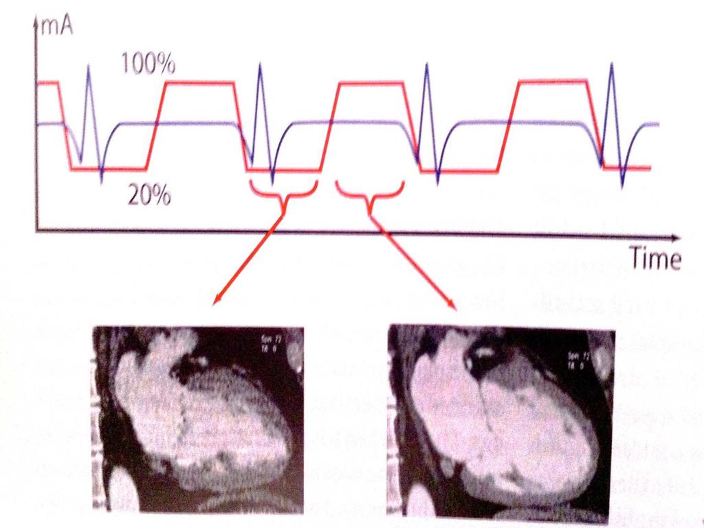 AEC et imagerie cardiaque La majorité des acquisitions sont faites en mode rétrospectif Développement d une modulation ECG-dépendante de la dose avec réduction d environ 50 % de la dose Réduction de