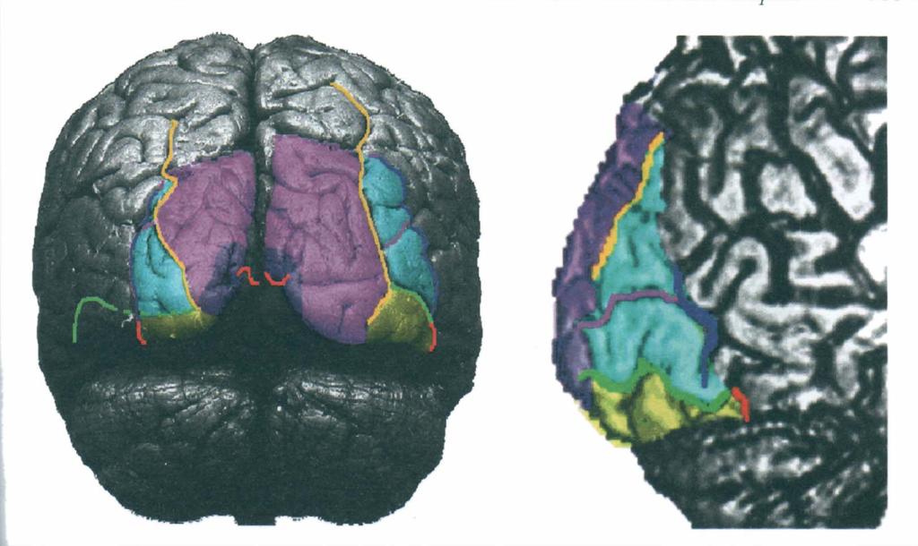 Lobe Occipital Sillon Intra Occipital Sillon Occipital inférieur Sillon Occipital Antérieur Scissure