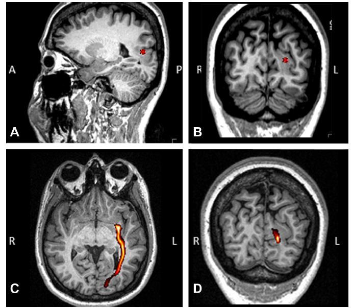 MRI revealed a cortical dysplasia, an abnormal thickening of the grey-white matter boundary, in