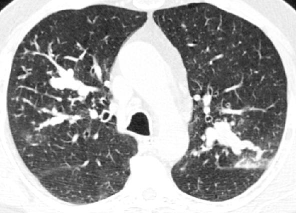 Les bronchocèles se développent aussi typiquement dans l aspergillose broncho-pulmonaire allergique (ABPA) où l on observe de multiples bronchectasies remplies de mucus (bronchocèles avec aspect