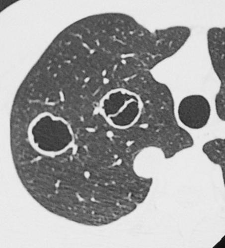 Cependant, ce dernier est caractéristique de la fibrose pulmonaire idiopathique (ou pneumopathie usuelle ou UIP) - kystes pulmonaires : * ce sont des cavités pulmonaires, arrondies, à paroi fine.