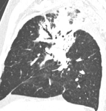 FIBROSE PULMONAIRE - il existe plusieurs causes de fibrose : * fibroses «primitives» : fibrose pulmonaire idiopathique, pneumopathies interstitielles non spécifiques. * fibroses médicamenteuses.