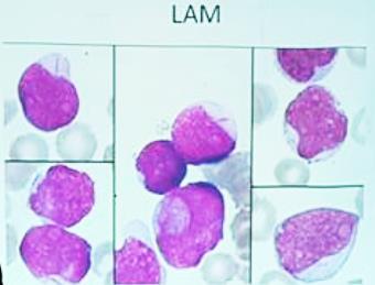 (souvent plus jusqu à 100%), divers critères morphologiques des blastes vont permettre de séparer les LA en 2 grands groupes : LA lymphoblastique : blastes de taille petite ou moyenne et cytoplasme