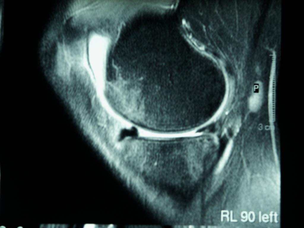 Lésion type «Anse de seau» Les différents signes : fragment luxé dans le compartiment Signe de la «trop grande» corne antérieure ( flipped meniscus)