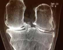 Arthrose fémorotibiale externe La radiographie montre une arthrose Kellgren-Lawrence grade IV avec un contact «bone on bone».