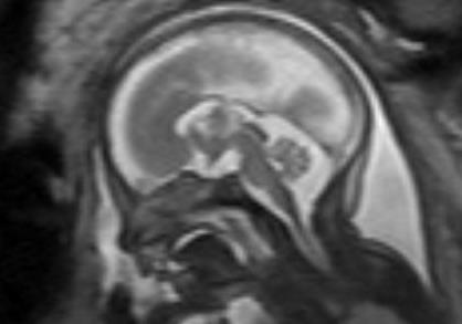 de quelques HNPV sur la corne temporale gauche IRM 25 SA.