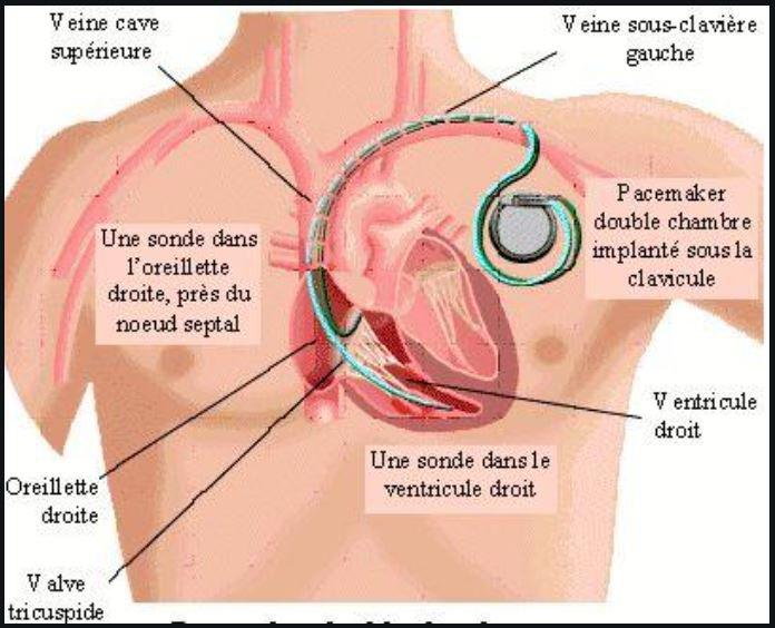 html Le battement cardiaque (révision 6.2) Les signaux reçus du noeud sino-auriculaire qui causent la contraction ne peuvent pas directement passer des oreillettes aux ventricules.