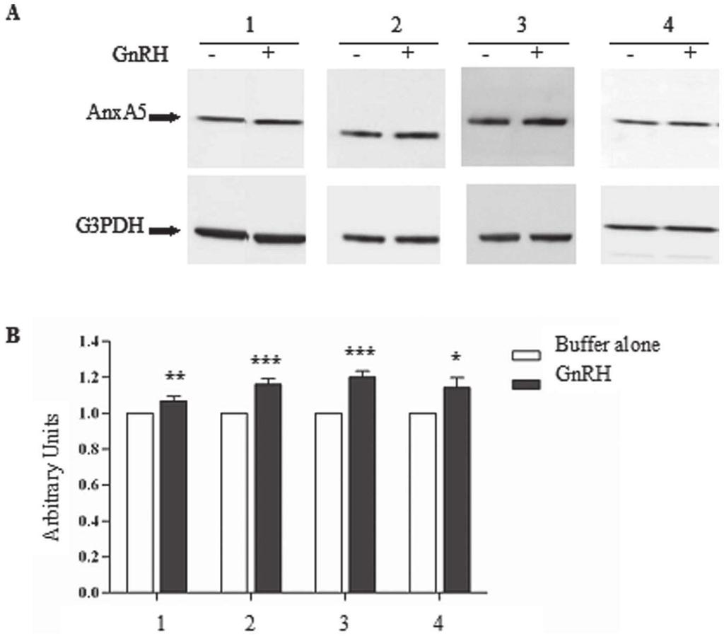 GnRH Improves Chloride Transport in CF Cells Figure 4. An