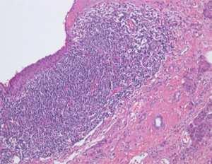 Cyst: An Atypical Benign Pancreatic