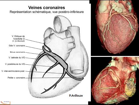 Généralités: morphologie Veines coronaires - réseau gauche à