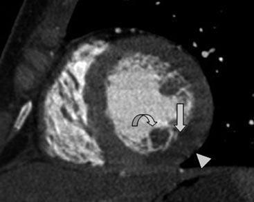 Diastole Systole inféro-latérale semblant respecter le sousépicarde en systole