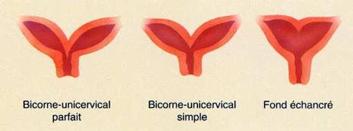 B.1 L utl utérus bicorne bicervical B.1.1 UBB avec rétention r menstruelle unilatérale Soit hémivagin borgne Soit atrésie d un d hémicol Dysménorh norhée primaire / hématométrietrie côté borgne
