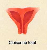 C.1 Utérus cloisonné total C.1 L utérus cloisonné total Absence complète de résorption de la cloison Aspect extérieur normal ou presque (légère encoche visible sur le fond utérin).