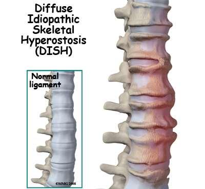 DISH La maladie de Forestier (ou DISH : diffuse idiopathic skeletal hyperostosis) est une spondylarthropathie non inflammatoire caractérisée par une ossification en coulée du ligament