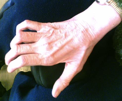 Amyotrophie progressive distale : mains et pieds
