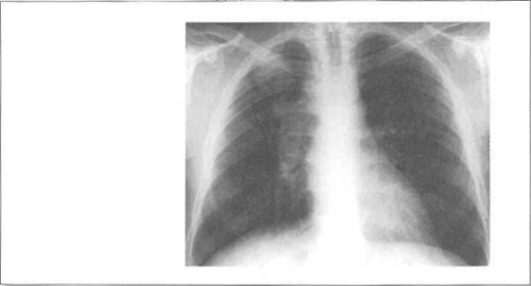 Ce semne de edem pulmonar pot fi observate pe o radiografie