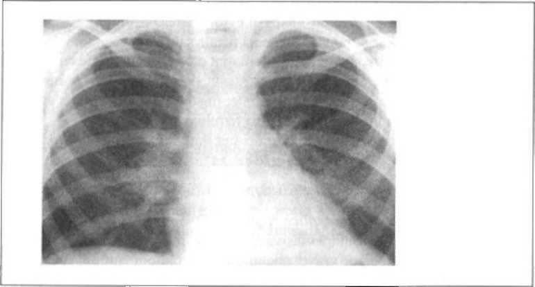pierderea în greutate pneumonie bacteriană)