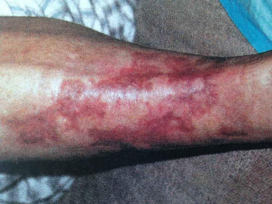 Voici la jambe du patient, 2 mois après la thérapie. La cicatrice visible ici a également totalement disparu par la suite.