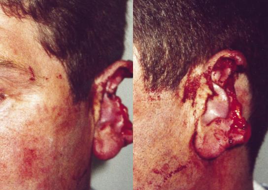 Photo 41 : Oreille du patient lors de son admission à l'hôpital (consultée le 25/02/17 sur l'article "Reconstruction of a large defect of the ear using a composite graft