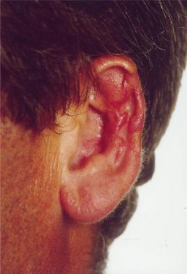 Photo 42 : Greffon présentant une congestion veineuse 48h après son implantation (consultée le 25/02/17 sur l'article "Reconstruction of a large defect of the ear using a