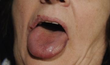 Haematoma of the tongue treated with medicinal leeches : a case report") Photo 51 : Langue après hirudothérapie (consultée le 28/08/15 sur "Ramzan M et Al. Leech got your tongue?