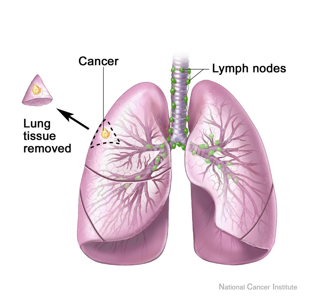 Résections pulmonaire en cancérologie Résections atypiques Résections anatomiques = réglées Pneumonectomie,