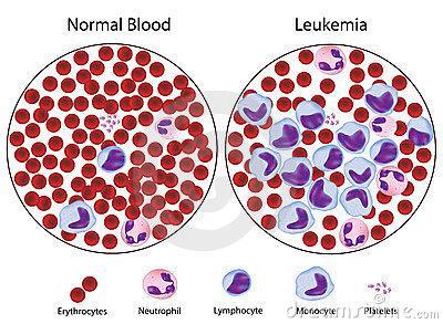 Dans ce type de leucémie, il y a deux grandes catégories qui se distinguent en fonction des caractéristiques des lymphoblastes.