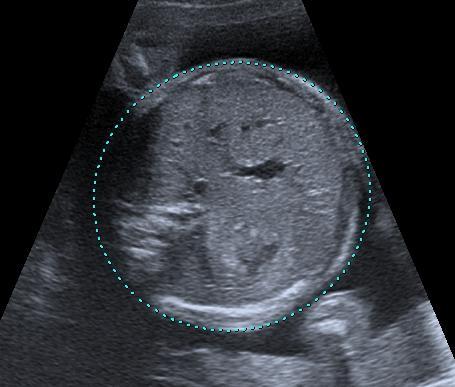 Les mesures des paramètres échographiques paramètre le plus pertinent pour le dépistage : Le poids fœtal (EPF) et périmètre abdominal (PA)